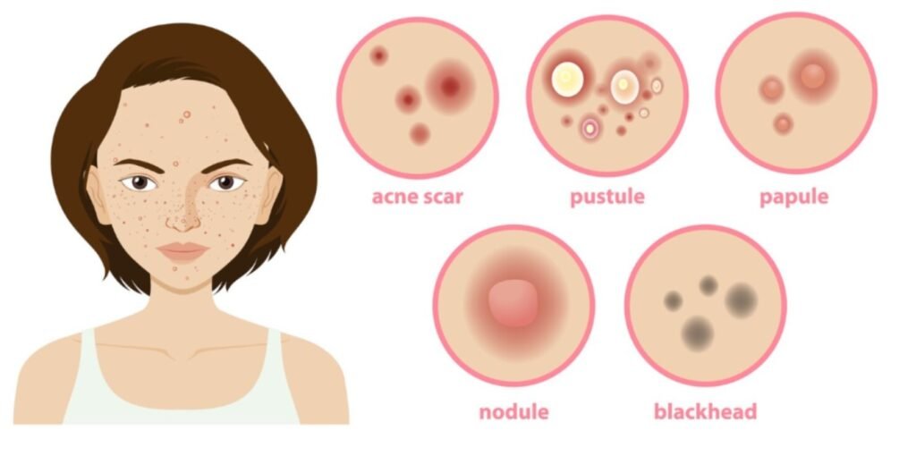How to Get Rid of Acne Scars? A Realistic, Science-Backed Guide That Actually Helps